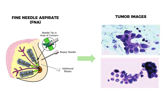 Breast Cancer Detection